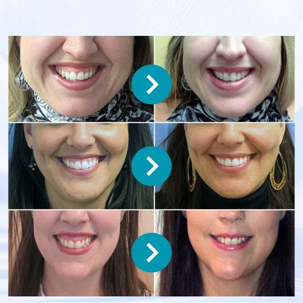 Penna sbiancante per denti JaySuing™