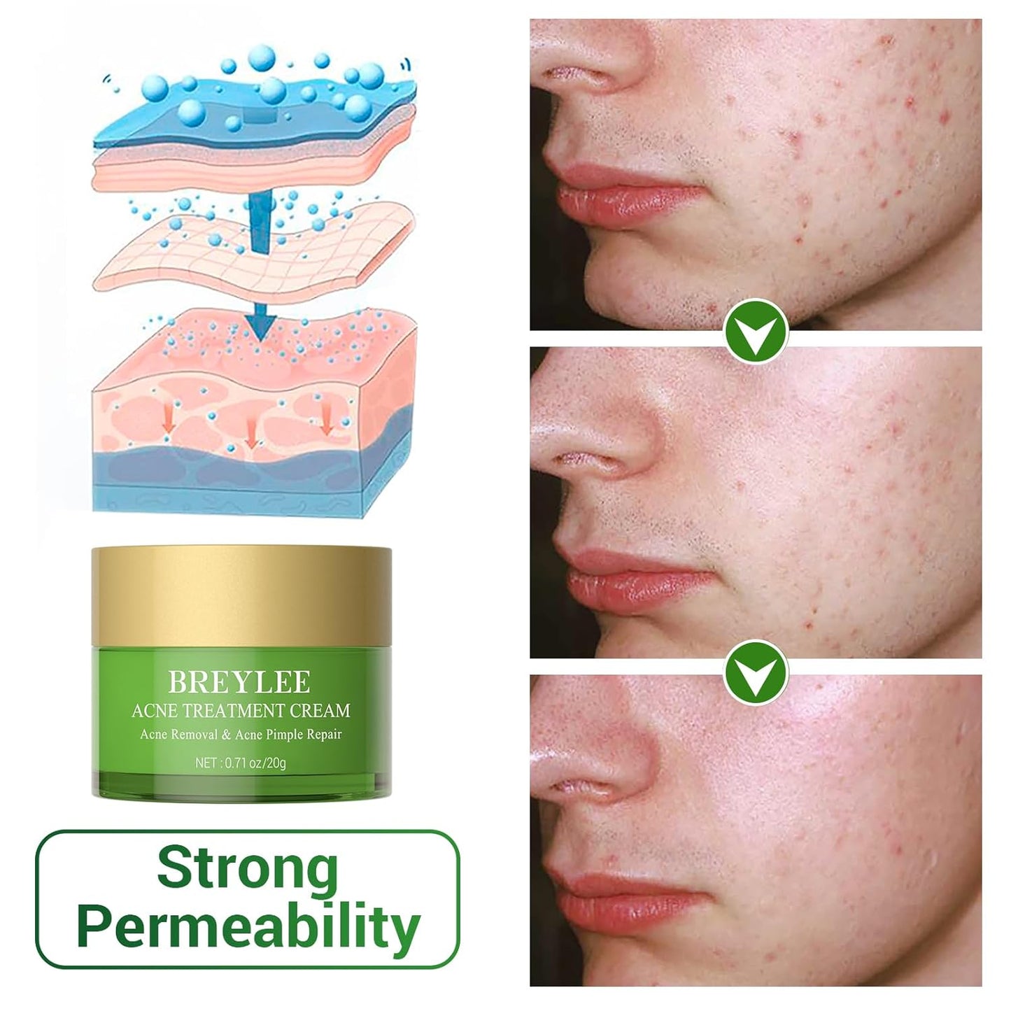 BREYLEE Crema per il trattamento dell'acne, Crema per l'acne all'olio dell'albero del tè per eliminare l'acne grave, gli sfoghi cutanei, rimuovere i brufoli e riparare la pelle (20 ml, 0,7 once)