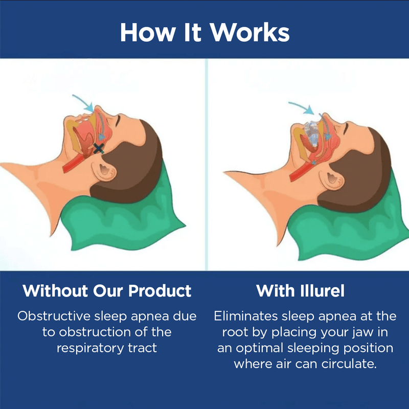 ONI Pro anti - snoring and sleep apnea orthosis - Sccoti