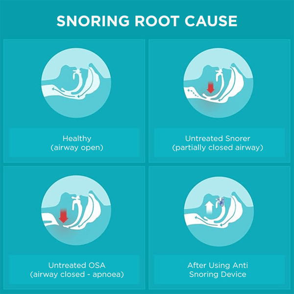 Flexible and adaptable anti - snoring and sleep apnea orthosis - Sccoti