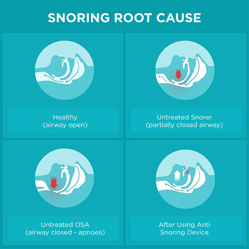 Flexible and adaptable anti - snoring and sleep apnea orthosis - Sccoti