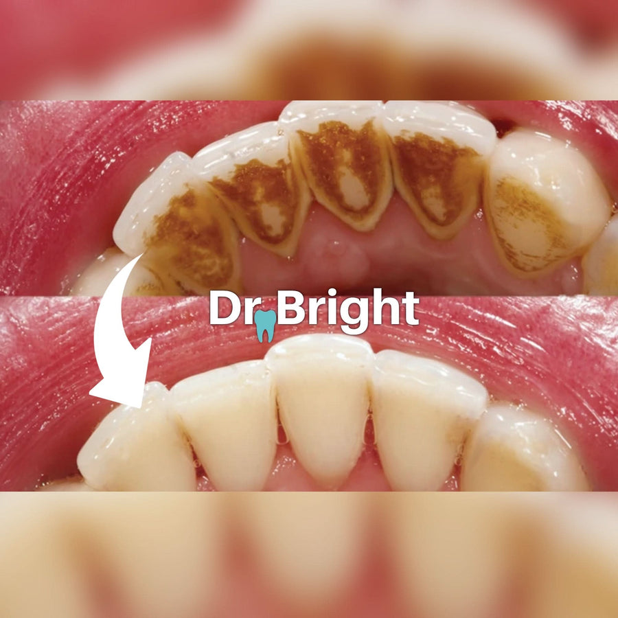 Dental Scaler (Compare to Densine™) - Sccoti